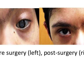 "Teen with Down Syndrome Sees the World Anew After Life-Changing Cataract Surgery"