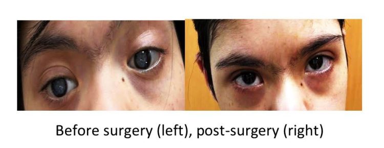 "Teen with Down Syndrome Sees the World Anew After Life-Changing Cataract Surgery"